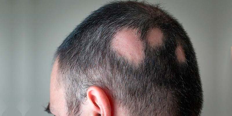 evitar tinción Limpia la habitación Tratamiento de la alopecia areata | Solución y causas (estrés y hormonas)