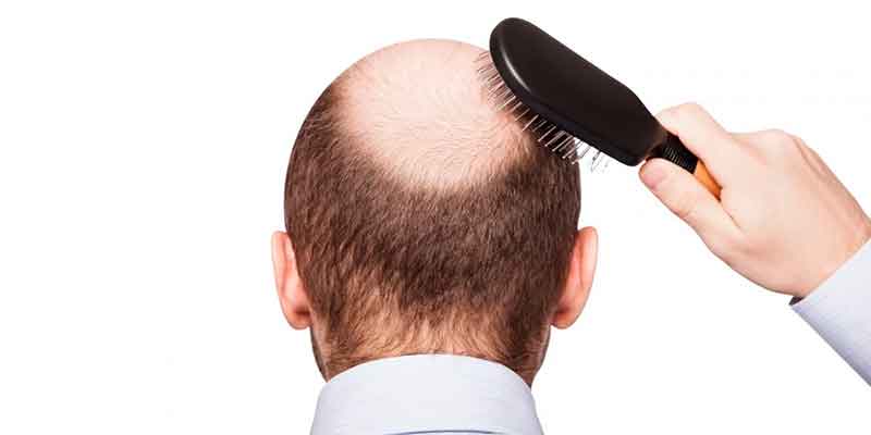 Cómo disimular la alopecia? Trucos para y mujeres