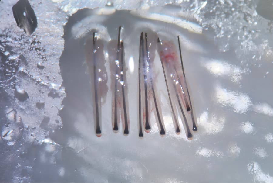 implante capilar malaga