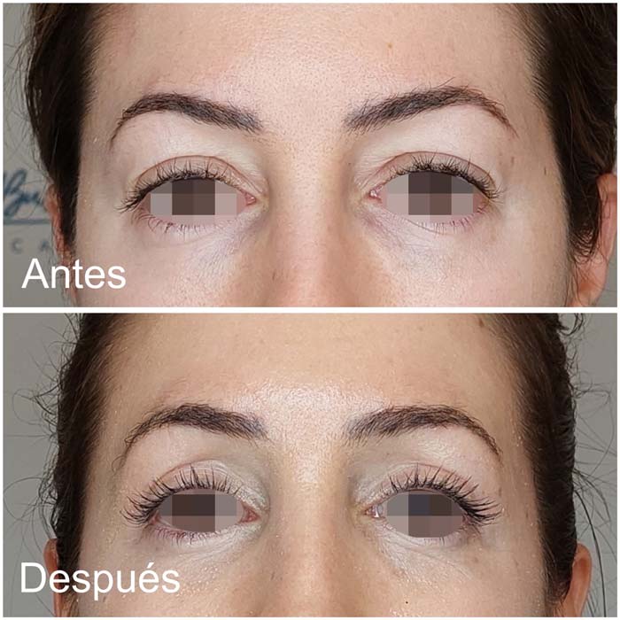 antes-despues-blefaroplastia-en-malaga