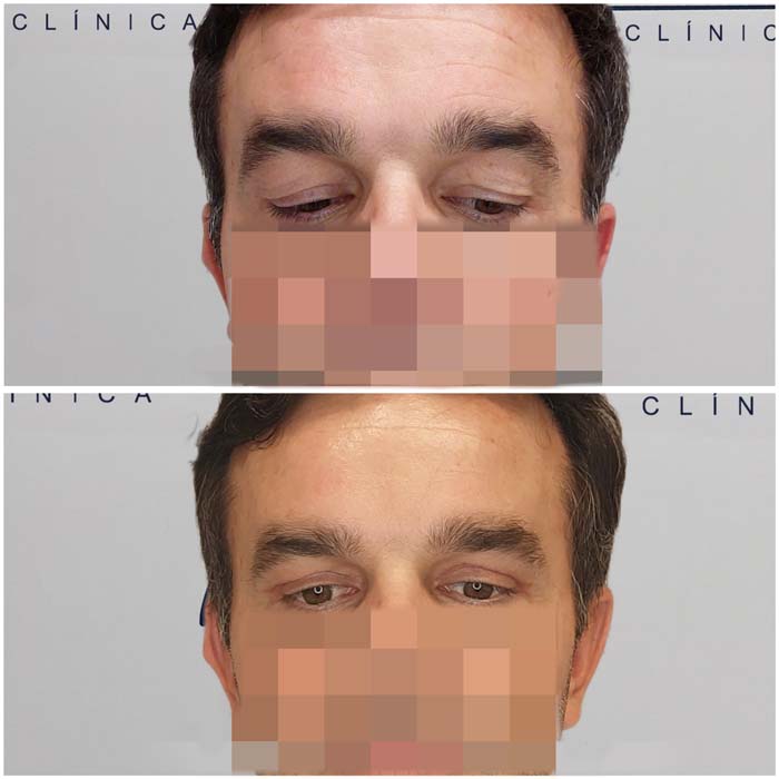 antes-despues-blefaroplastia-malaga