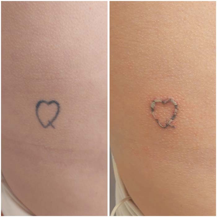 resultados eliminar tatuajes en malaga