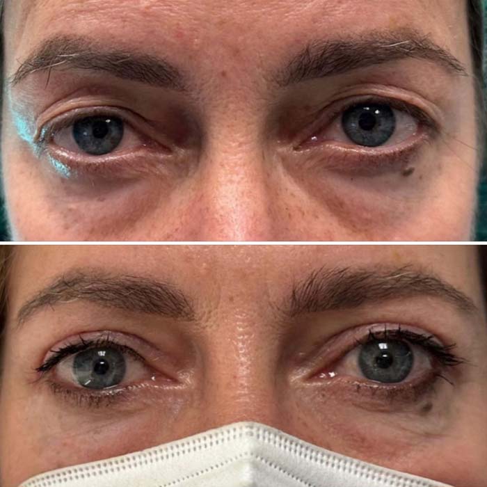 antes-despues-tratamiento-blefaroplastia-malaga