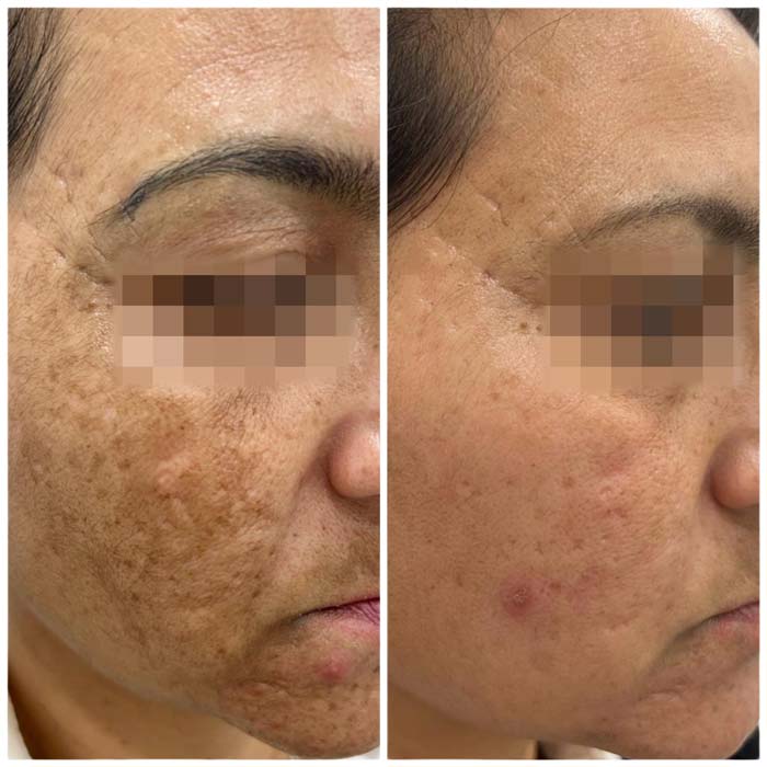 antes y despues de tratamiento manchas faciales en malaga