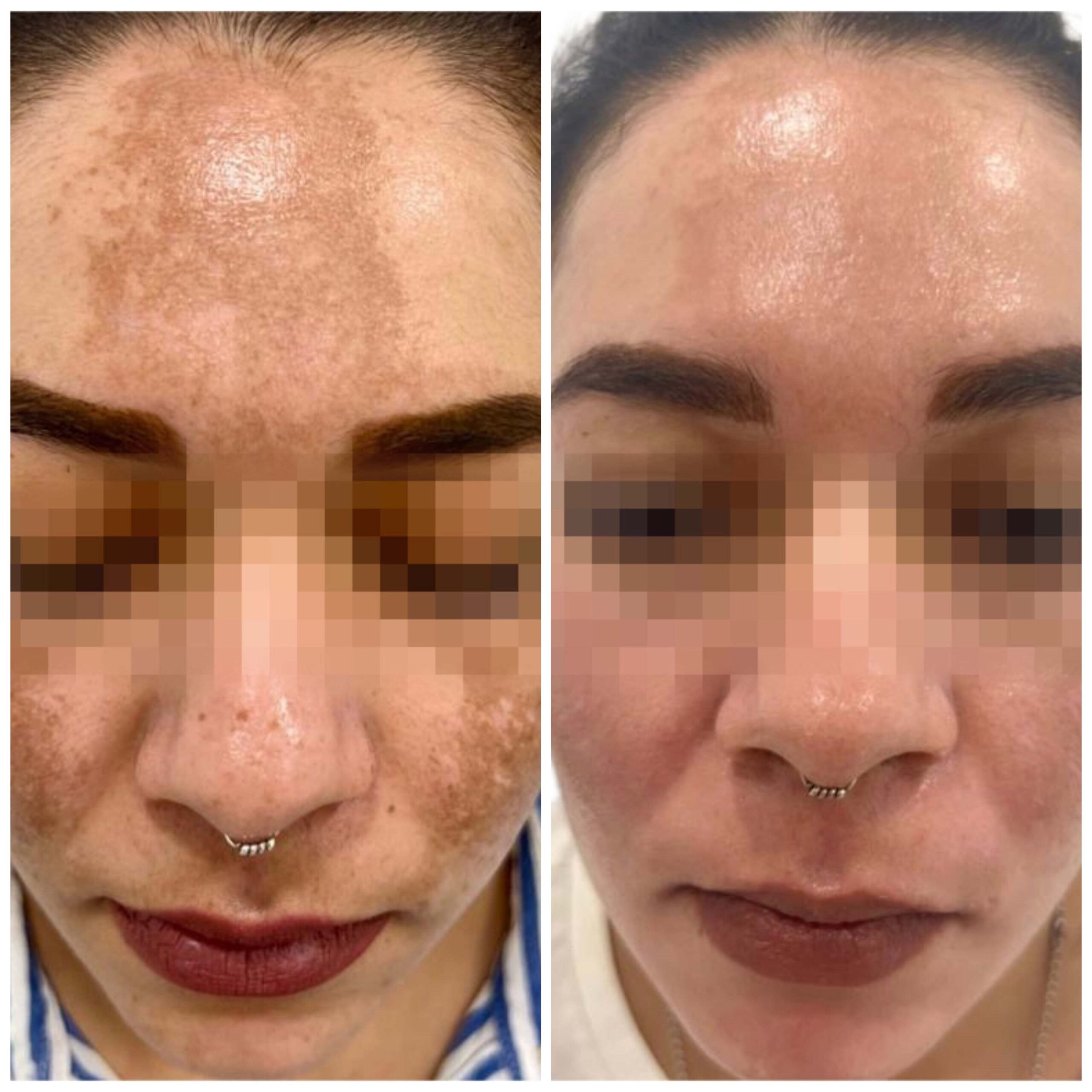 antes-despues-melasma-malaga