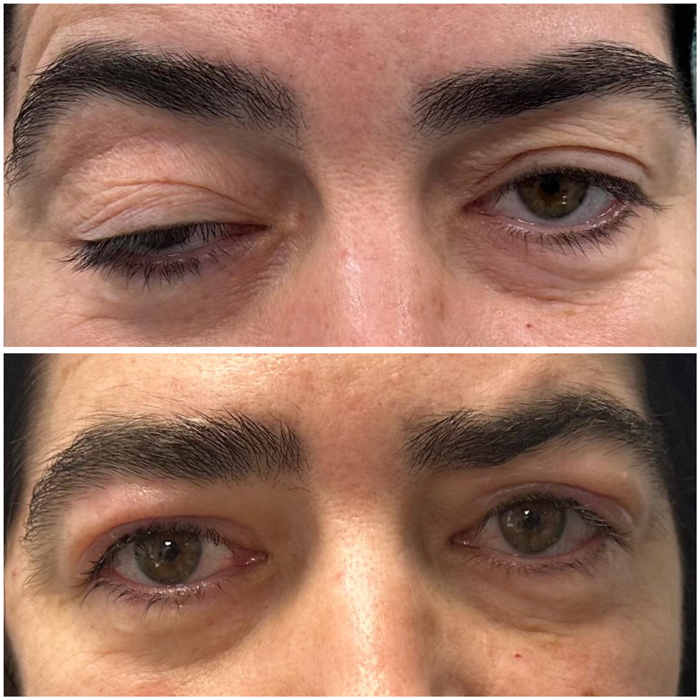 antes despues tratamiento ptosis palpebral malaga