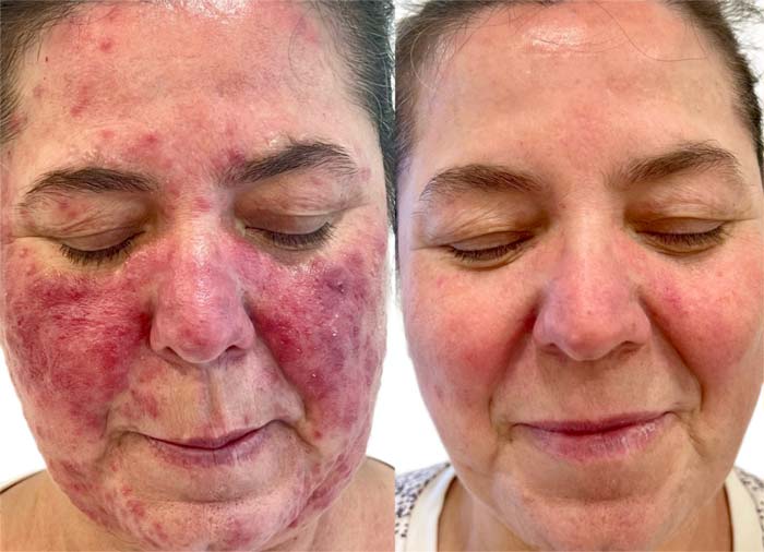 antes despues tratamiento rosacea malaga