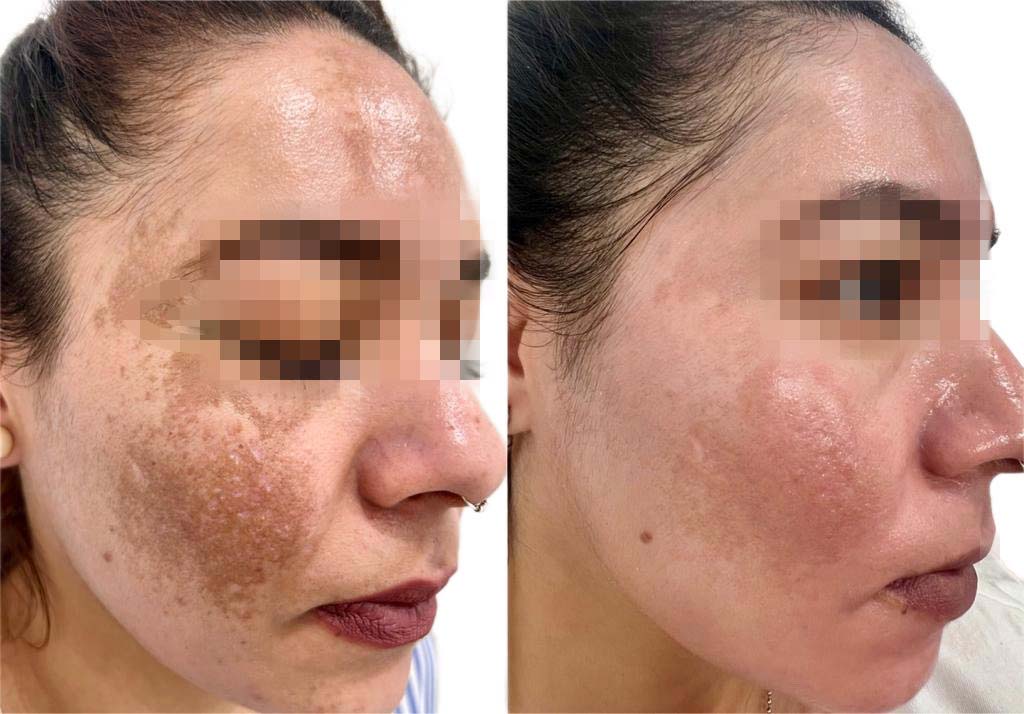 antes-despues-tratamiento-melasma-malaga