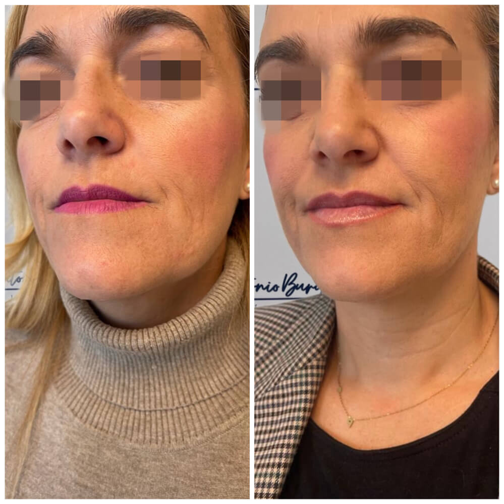 antes-despues-aumento-labios-clinica-antonio-burgos-1