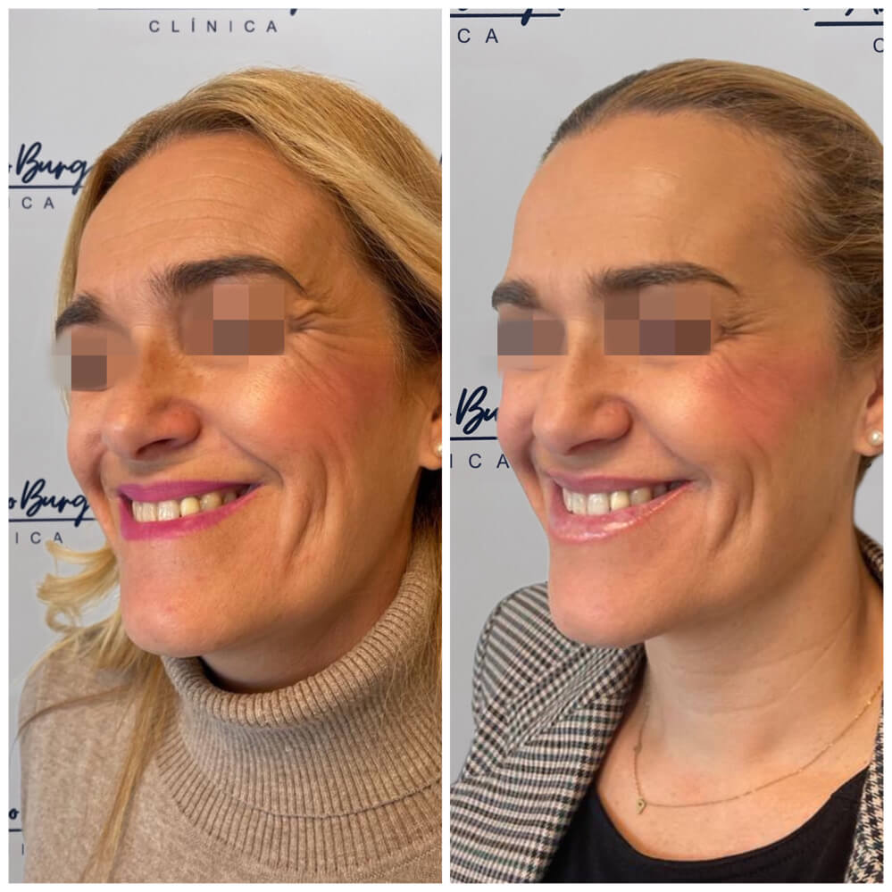 antes-despues-aumento-labios-clinica-antonio-burgos-2