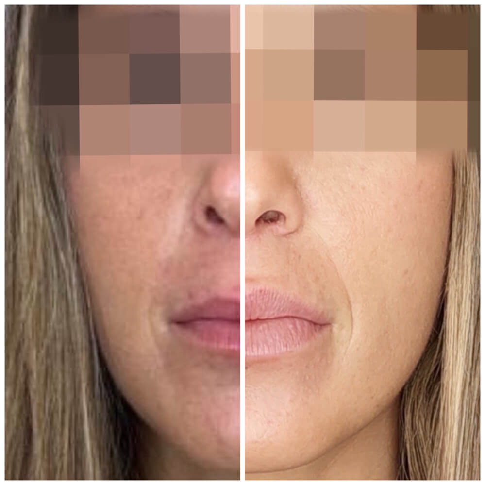 antes-despues-aumento-labios-clinica-antonio-burgos-4