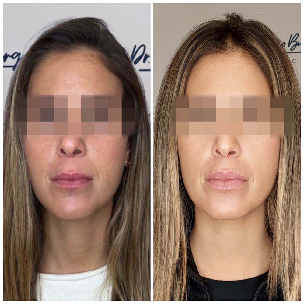 resultados aumento de labios