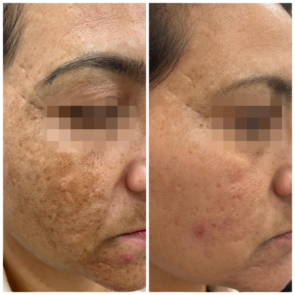 antes-despues-tratamiento-melasma-1