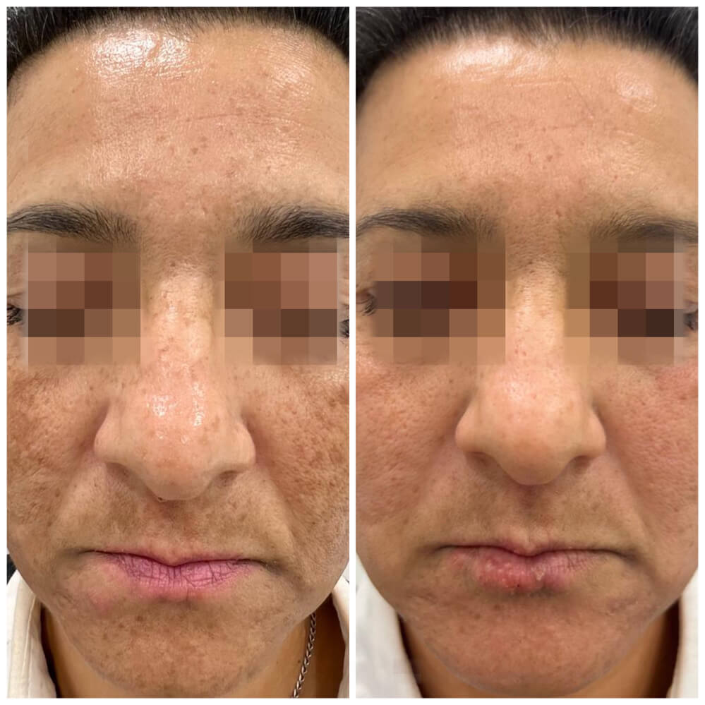 tratamiento melasma malaga