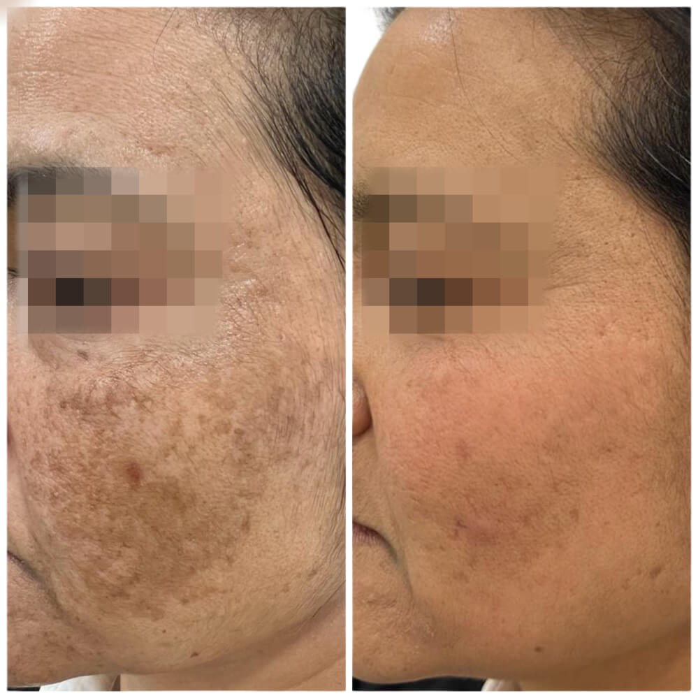 antes-despues-tratamiento-melasma-3