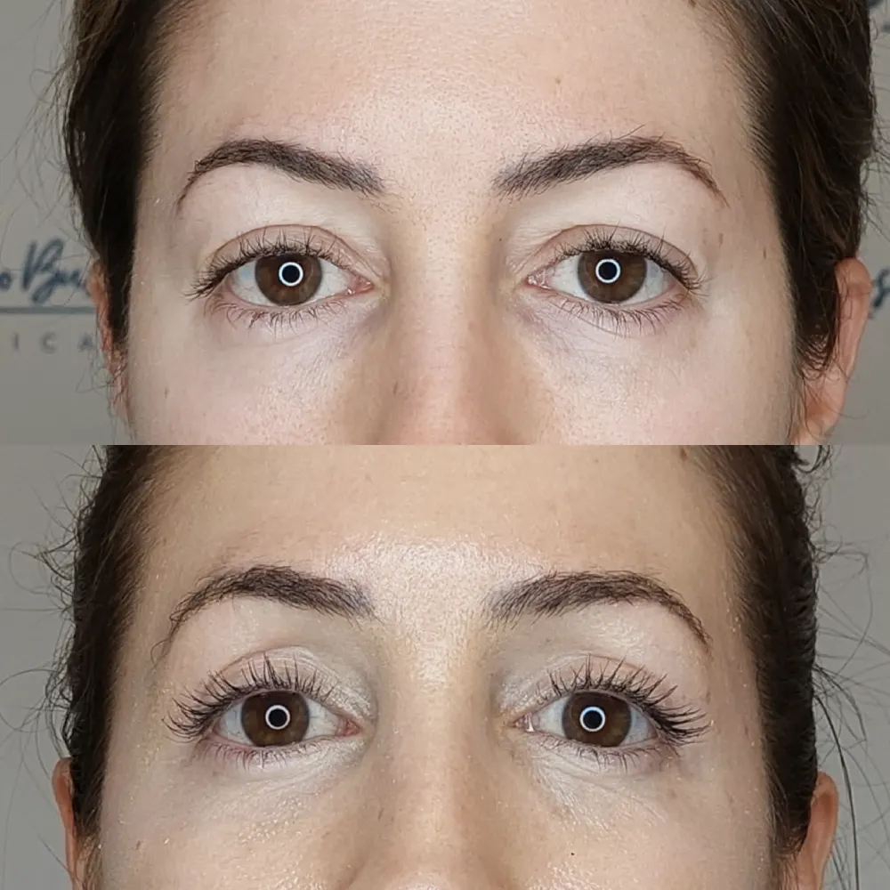 antes y despues operacion blefaoplastia malaga