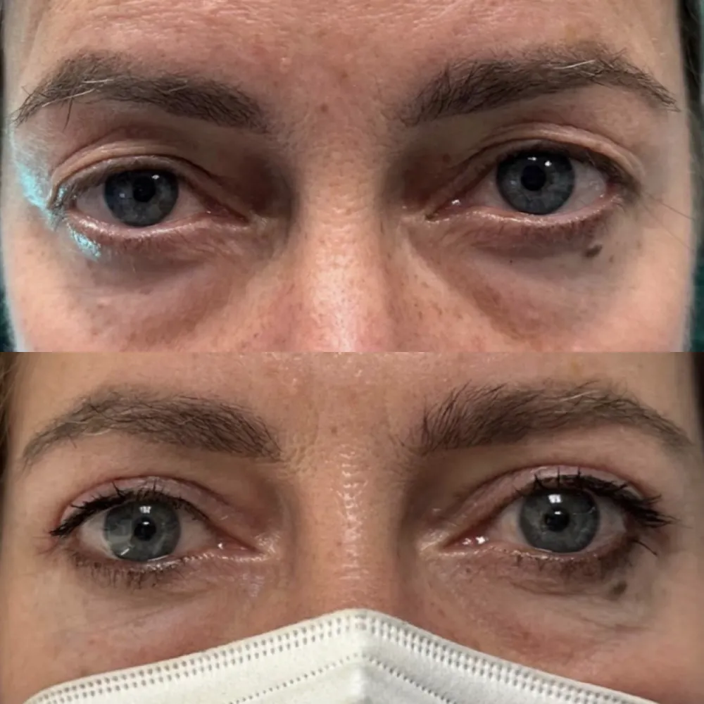 blefaroplastia-parpado-superior - mujer