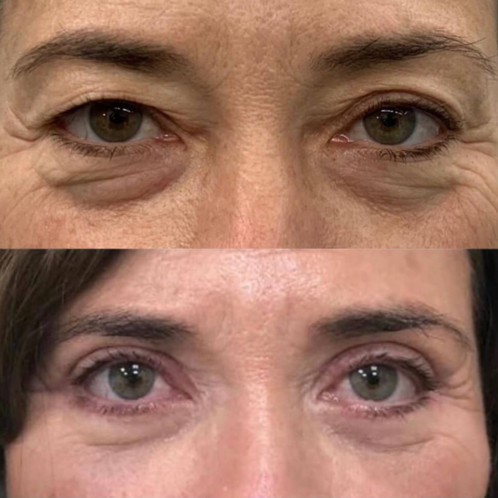 antes y despues en blefaroplastia malaga