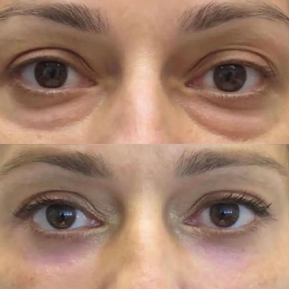 antes y despues en cirugia blefaroplastia malaga