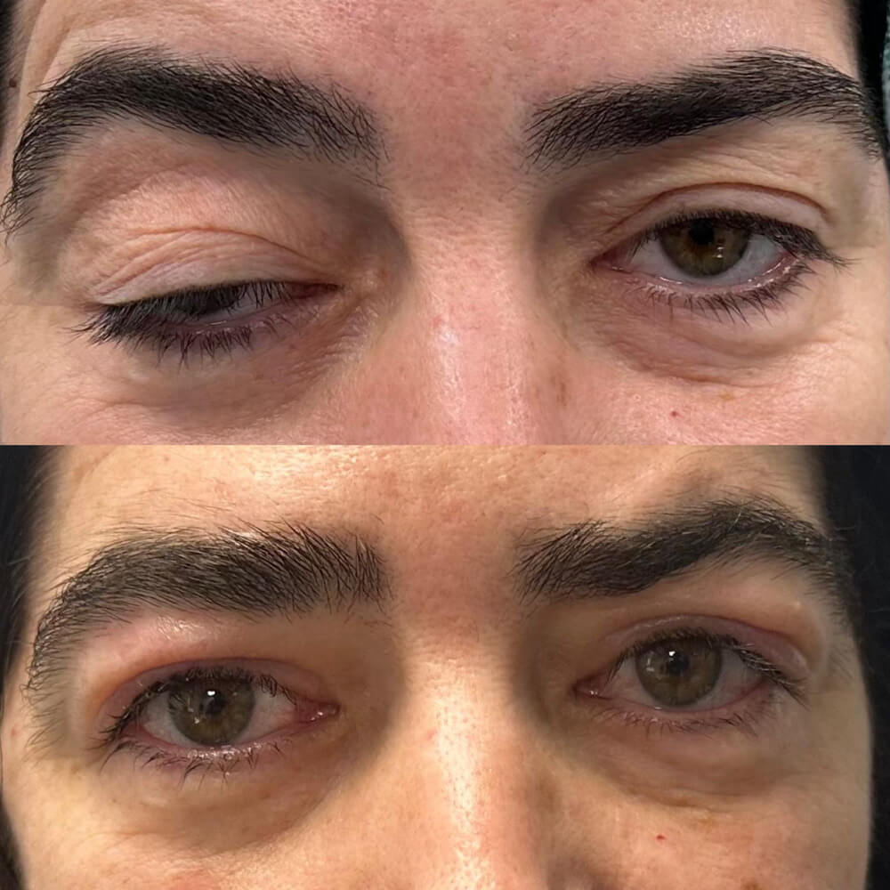 resultados-blefaroplastia-malaga-clinica-antonio-burgos-3