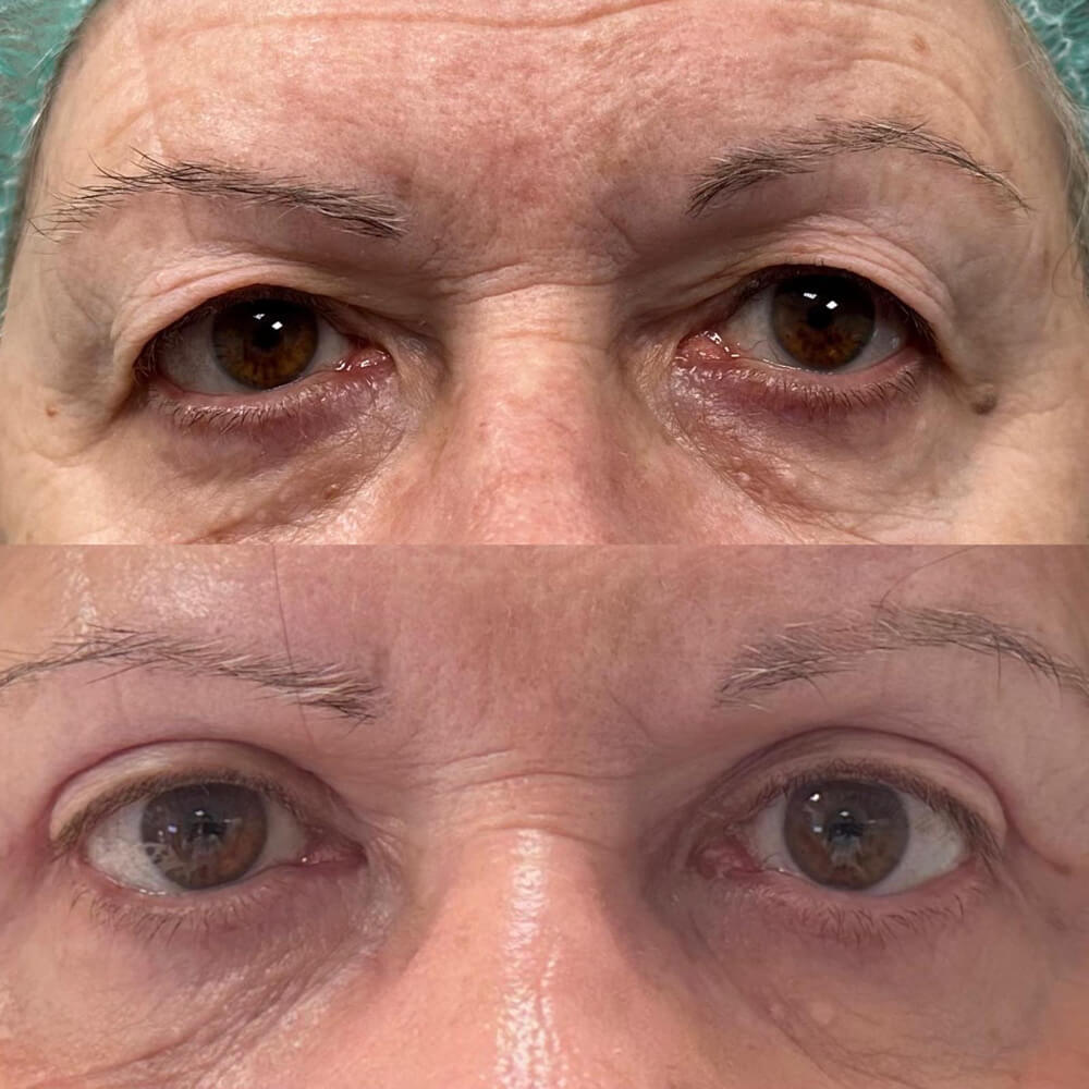 antes y despues blefaroplastia malaga operacion