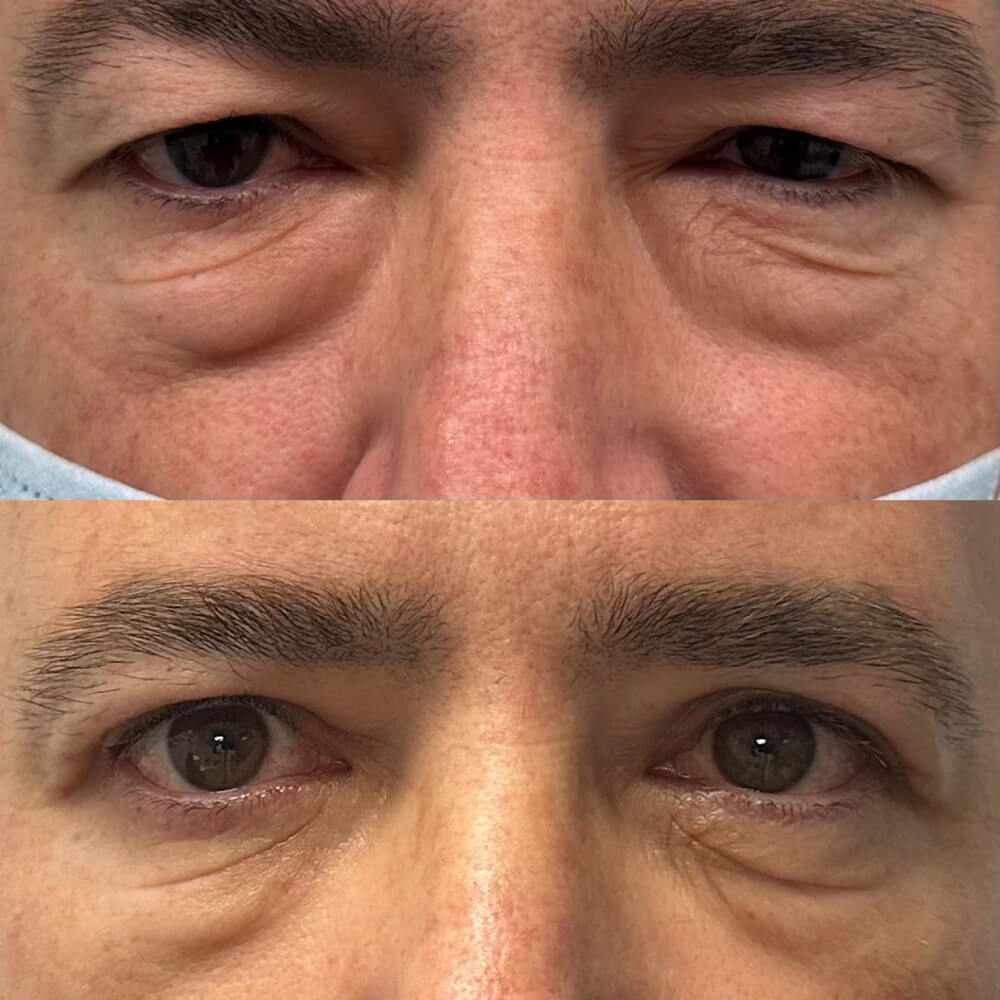 resultados-blefaroplastia-malaga-clinica-antonio-burgos-5