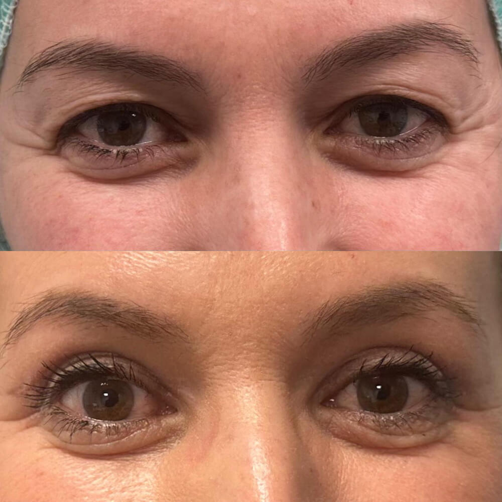 resultados-blefaroplastia-malaga-clinica-antonio-burgos-6