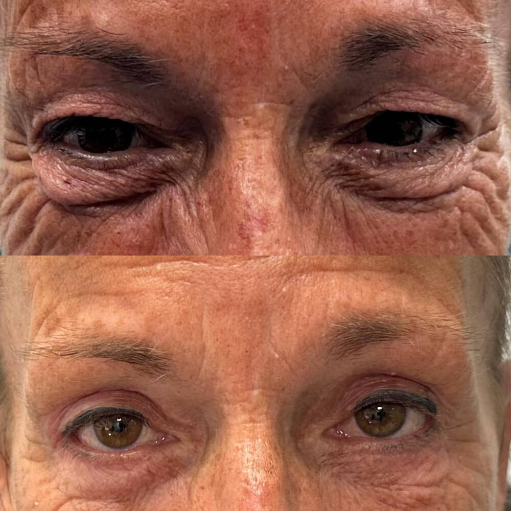 blefaroplastia en malaga capital