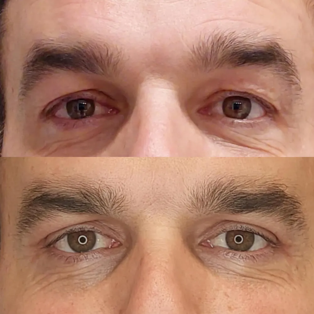 resultados-blefaroplastia-malaga-clinica-antonio-burgos-82