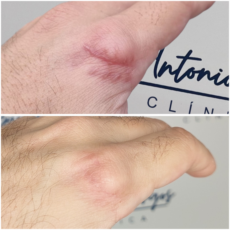 antes y despues eliminacion de cicatrices malaga