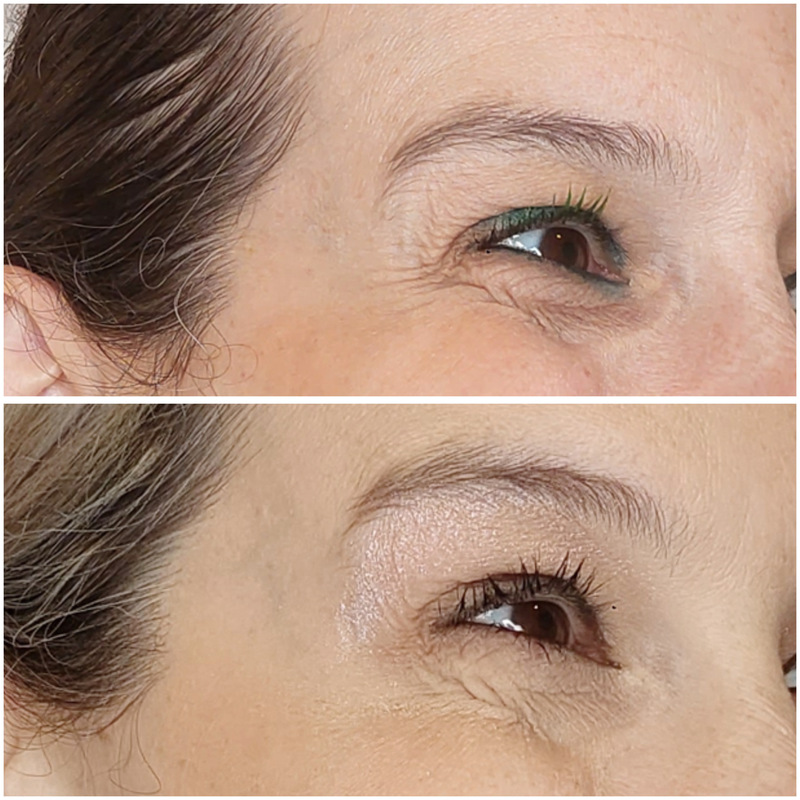 antes y despues mujer tratamiento neuromoduladores malaga