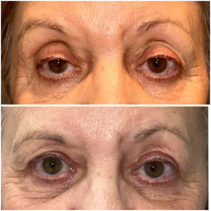 resultados blefaroplastia superior malaga