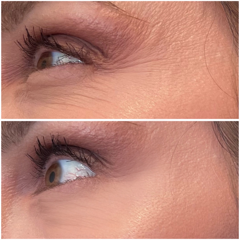 antes y despues laser co2 periocular
