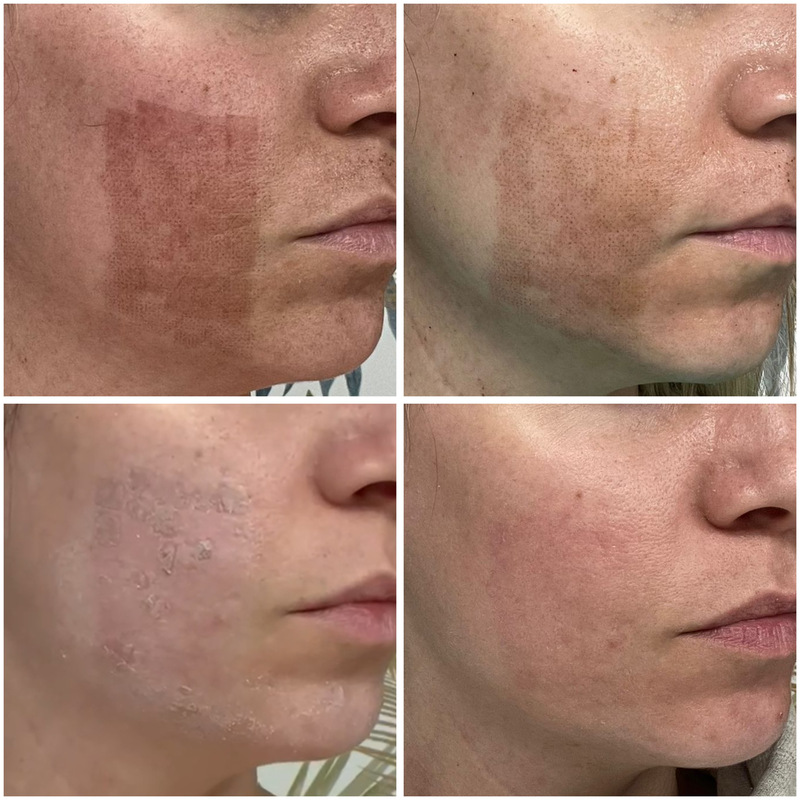 antes y despues laser co2