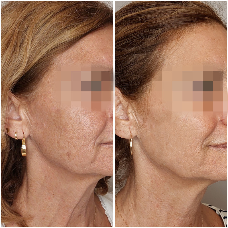 resultados tratamiento manchas faciales malaga