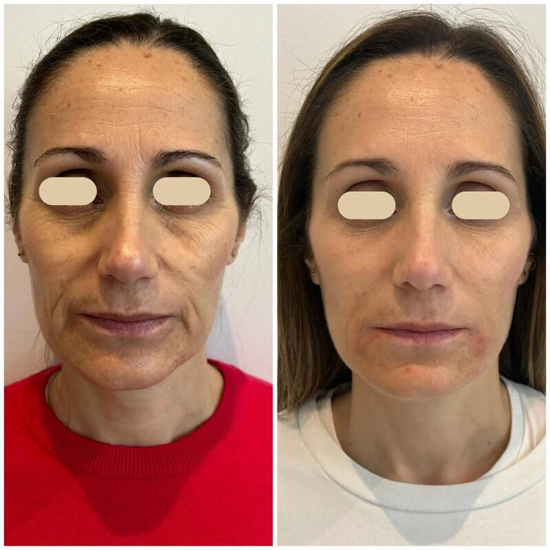 antes y despues tratamiento facial acido hialuronico