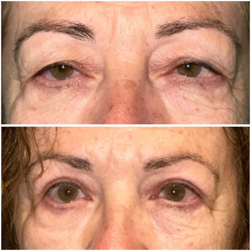 resultados blefaroplastia malaga