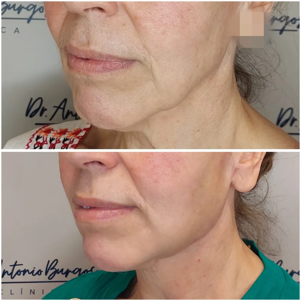 antes y despues endolift en malaga