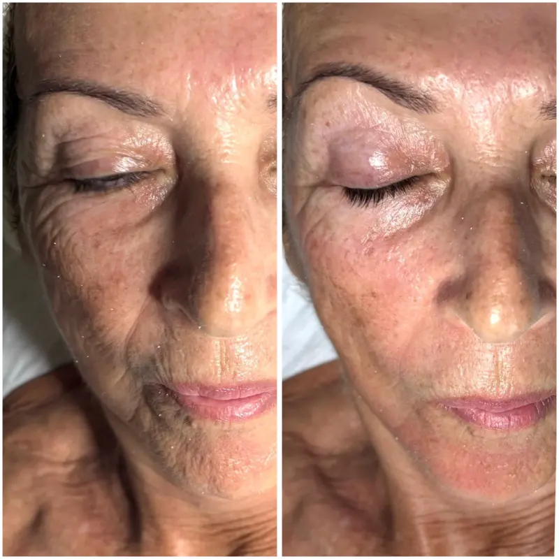 resultados tratamiento microneedling en malaga