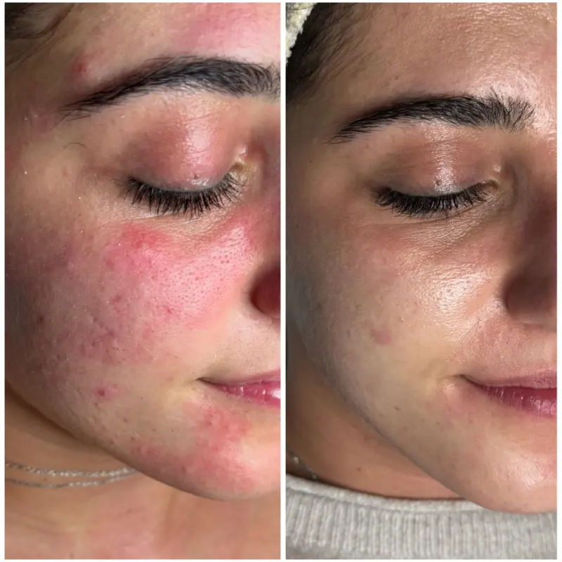 antes y despues tratamiento microneedling en malaga
