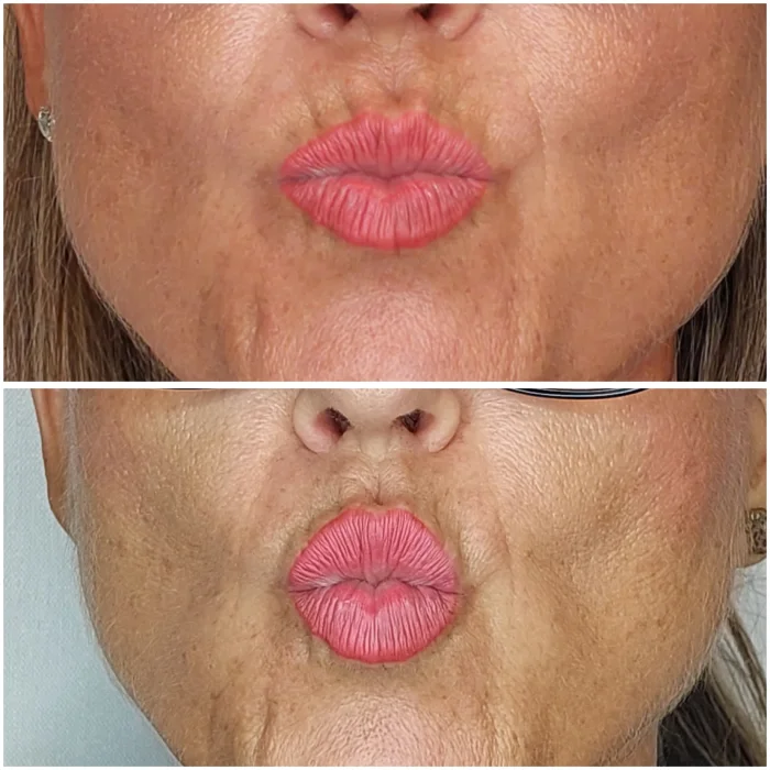 resultados aumento de labios en hombre