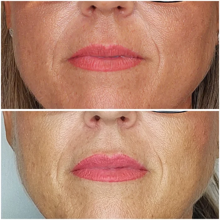 resultados rellenos de labios