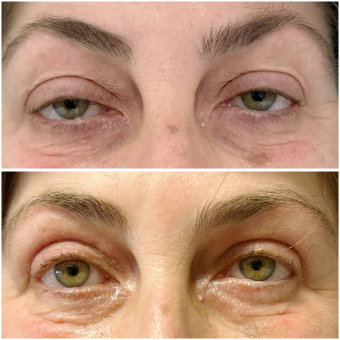 blefaroplastia antes y despues malaga