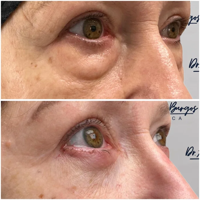 blefaroplastia resultados malaga