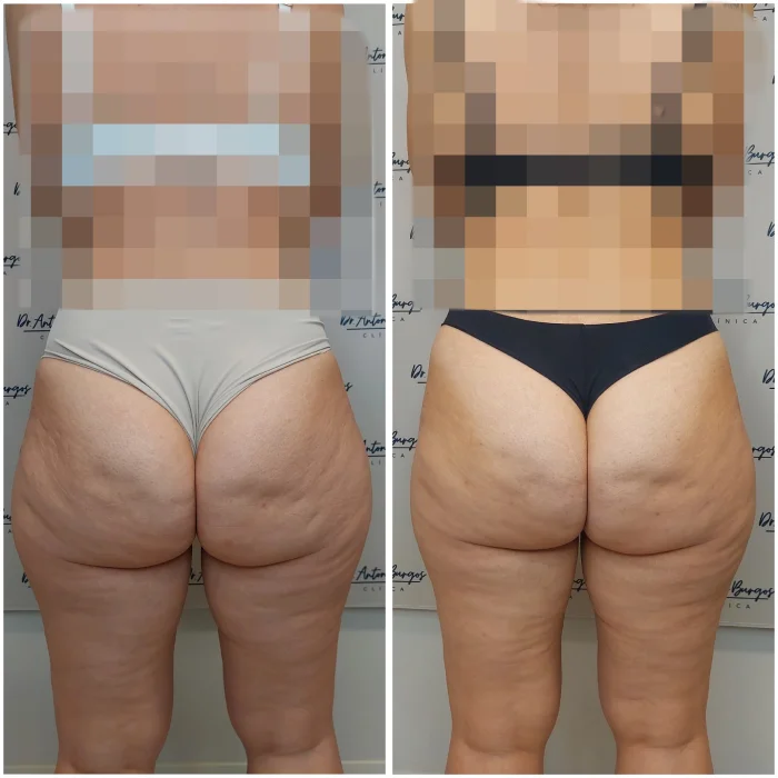 endolift celulitis antes despues malaga 25 11