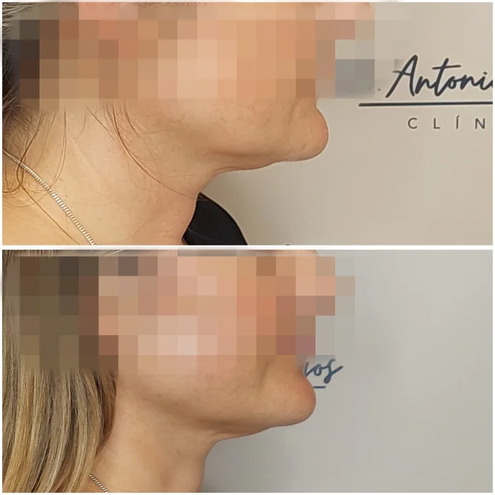 endolift tercio inferior antes despues malaga 25 11 2