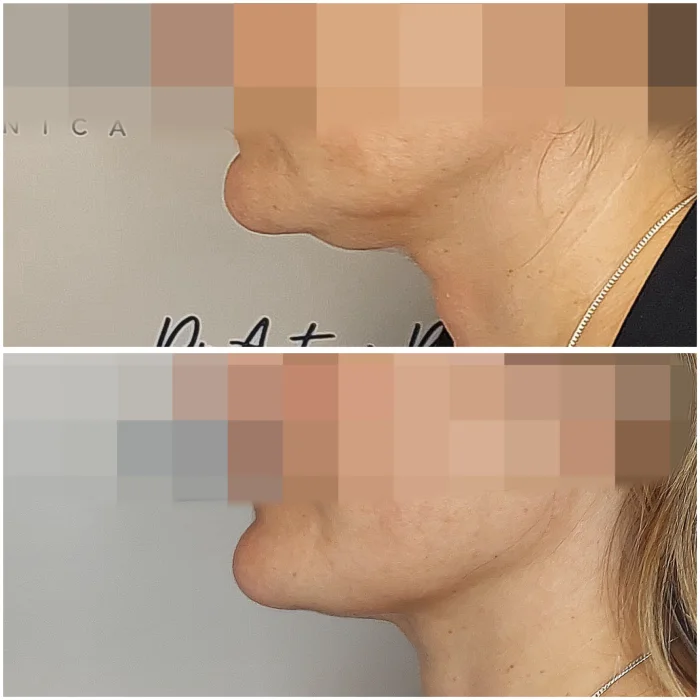 endolift tercio inferior antes despues malaga 25 11