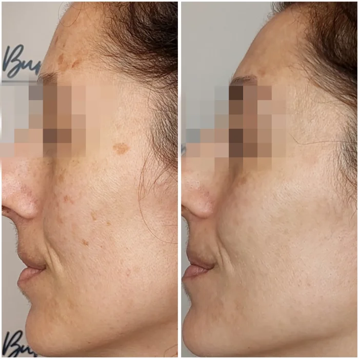 eliminacion de manchas faciales con ipl fotos