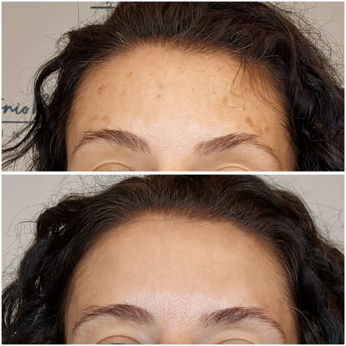 manchas faciales frente antes despues