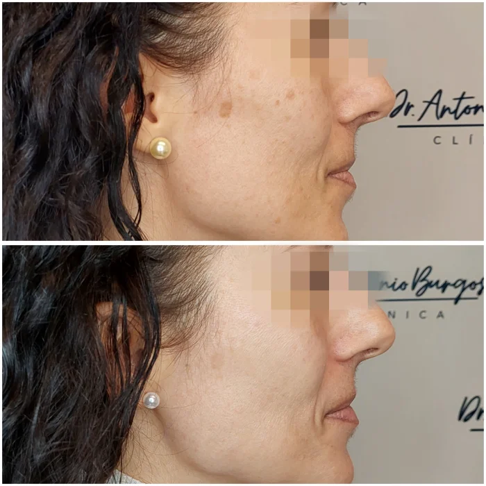 restultados tratamiento ipl manchas faciales